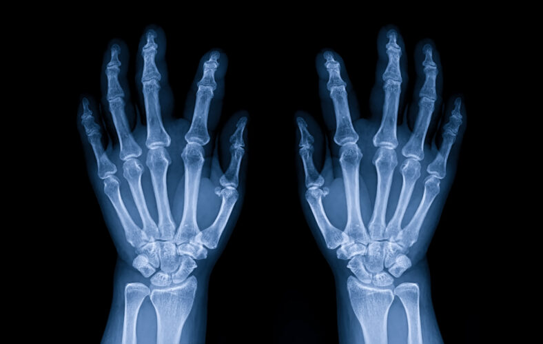 Blue tone radiograph on dark background in hospital.Doctor used xray for diagnosis of the illness of patient.Normal x-ray of both hands. Osteoarthritis of hand and joint. X-ray both hands in hospital.